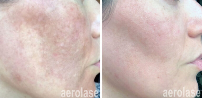 aerolase-neoskin-melasma-Rachel Lowe, LE, Yael Halaas, MD, FACS