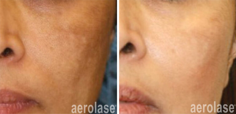 aerolase-neoskin-melasma-after-1-treatment-cheryl-burgess