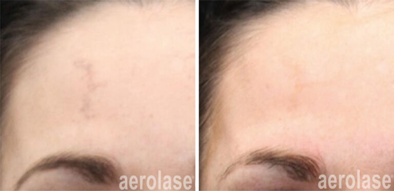 aerolase-neoskin-melasma-after-1-treatment-combined-with-salicylic-peel-suneel-chilukuri