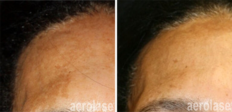 aerolase-neoskin-melasma-after-1-treatment-combined-with-tca-peel-cheryl-burgess