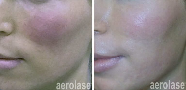 aerolase-neoskin-rosacea-kevin-pinski-after-1-treatment