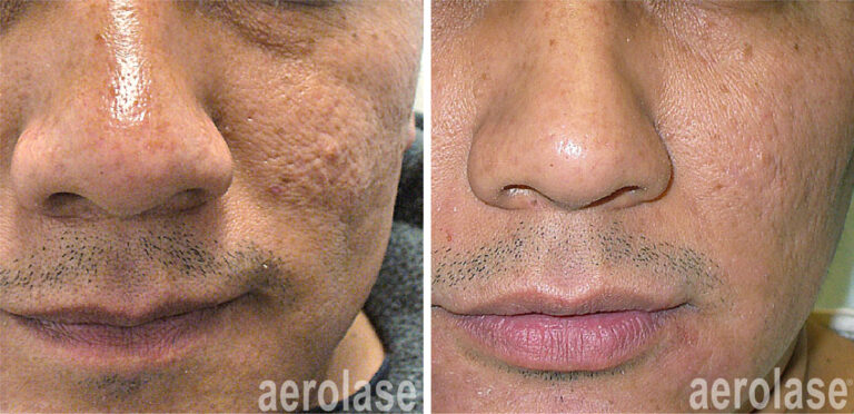 aerolase-skin-rejuvenation-fran cook bolden-after-7-treatments